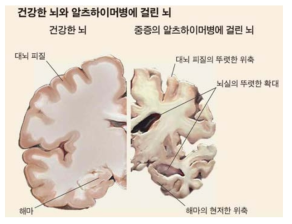 정상인과 알츠하이머병 환자의 뇌
