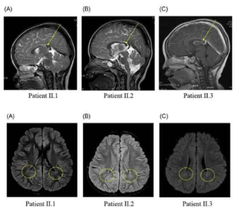 Axial T2-weighted magnetic resonance image (upper) and FLAIR magnetic resonance (down) of patients