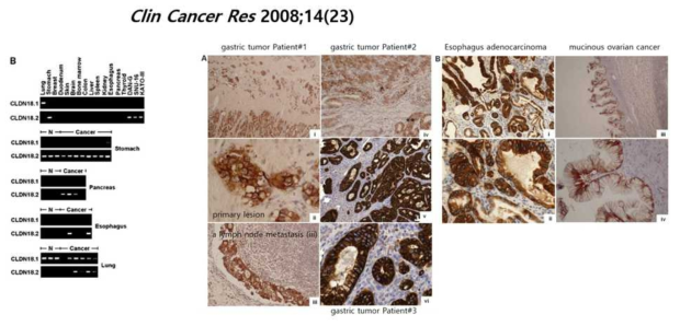 claudin18.2 mRNA 및 단백질 발현 확인 (Clin Cancer Res 2008;14(23))