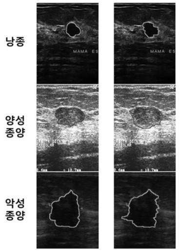 병변 영역 검출 결과. (L) 본 시스템이 검출한 병변 연역 (R)방사선 전문의가 진단한 병변 영역