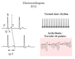 QT interval 연장시의 심장 전기생리변화