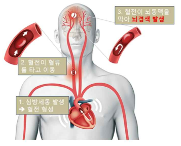심방세동의 뇌경색 발생 기전