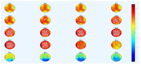 EO 상태의 안정기 뇌파에서 우울군과 정상 대조군에서의 RCMPE 차이. *표시는 cluster permutation test를 통과한 channel의 위치를 표시