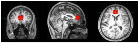 MRS 신호를 획득한 전대상회(pregenual anterior cingulate cortex)