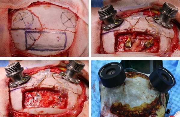 영장류 대뇌 전극 어레이 삽입 수술 사진. 일차운동피질 (좌), 후두정엽 (우)에 96채널 전극 어레이 삽입