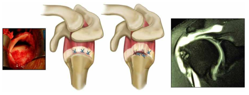 만성 광범위 어깨 힘줄 파열과 어깨 힘줄 봉합술 후 재파열 (좌: 디지털 사진, 우: MRI 사진)