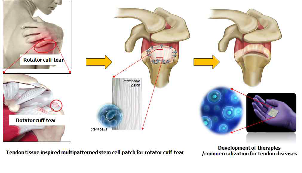 [연구개념] 줄기세포 및 힘줄 모사형 멀티스케일 지지체를 이용한 만성 어깨 힘줄파열 치료법 개발. 어깨 힘줄 파열 치료를 위한 새로운 봉합지지체인 힘줄 모사형 멀 티스케일 줄기세포 패치 개발 (1세부) 및 이를 활용한 만성 어깨 힘줄파열 치료법 확립 (2세부) 및 산업화