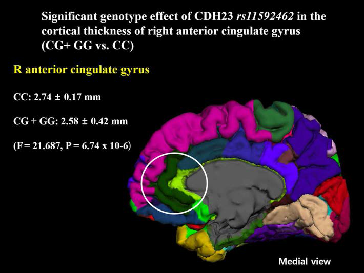 CDH23 유전자 rs11592462 SNP 유전형과 대뇌 피질 두께 간의 상관 관계 (우울증 환자 및 정상 대조군 포함 전체 표본)