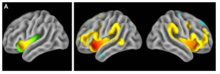 probability map of the functionally segmented anterior insular subregions