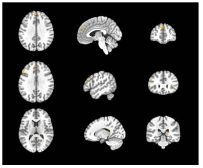 Matching block의 negative emotional stimuli condition에서 건강 대조군에 대한 청년기 우울증 고위험군의 뇌 영역 활성화 패턴 차이