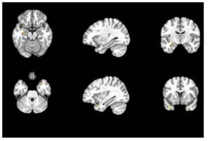 Matching block의 neutral emotional stimuli condition에서 건강 대조군에 대한 주요우울장애 환자군의 뇌 영역 활성화 패턴 차이