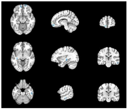 Incongruent > Congruent condition 에서 건강 대조군에 대한 주요우울장애 환자군의 뇌 영역 활성화 패턴