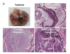 생체내 생성된 Teratoma