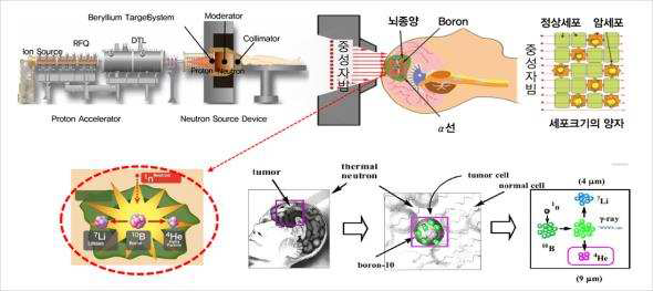 BNCT용 가속기 및 치료