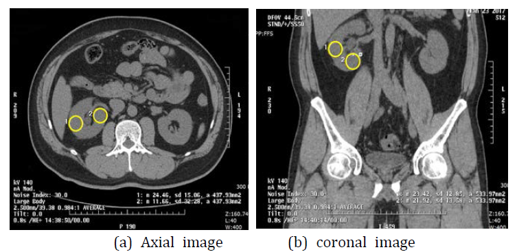 Setting up the ROI for quantitative analysis in axial, coronal images
