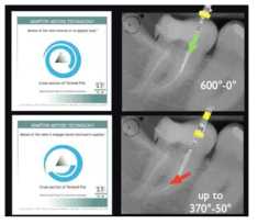 Adaptive reciprocating motion을 설명하는 모식도. 600도 이상 정방향 회전을 하다가 하중이 높아지는 경우 반대방향으로 50도 역회전을 하고 다시 정방향으로 회전하도록 고안되어 있음