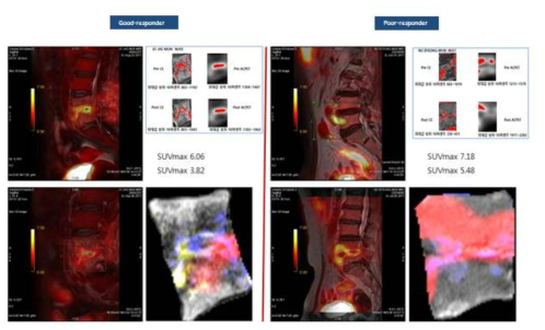 치료에 반응이 좋은 환자(좌)와 좋지 않은 환자(우)의 치료 전, 후 PET/MRI이다. 치료 반응이 좋은 경우가 그렇지 않은 경우에 비하여 SUVmax값이 유의하게 감소하고 FDG의 분포(각 환자의 우측 하단 영상에서 붉은색으로 표기, 다른 색들은 MRI의 세부영상에서 보이는 특정 신호가 영상으로 변환된 상태)가 척추뼈에서 디스크 주위로 한정되는 모습을 확인할 수 있다. 하지만 치료 반응이 좋은 않은 경우에는 FDG의 분포가 척추체 전반에 걸쳐 지속되는 양상을 보임