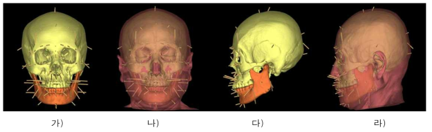 얼구피부두께 자료와 방향벡터를 이용한 얼굴두께 표현(여자, 67세). 가) 머리뼈와 피부두께기둥, 정면. 나) 실제모델과의 비교, 정면. 다) 머리뼈와 피부두께기둥, 측면. 라) 실제모델과의 비교, 측면