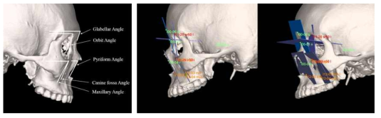 왼쪽, 3D 머리뼈 모델에서 각도 변화를 계측한 5군데 부위를 표시한 사진 오른쪽, 미믹스(3차원 계측 소프트웨어)를 이용한 각도 측정