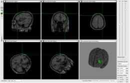 Navigation imaging of DLPFC target