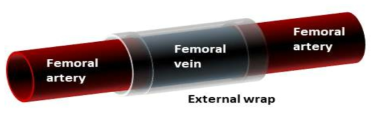 Vein to artery graft 부위를 형상기억 고분자를 이용하여 포장한 모식도