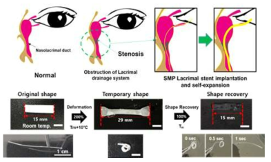 형상기억 고분자를 이용한 누관 그래프트의 개발 및 형상기억능 확인