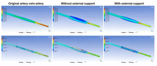 혈관 포장술 시행 후 정맥의 과팽창 방지에 따른 혈류 와류 생성 억제 시뮬레이션