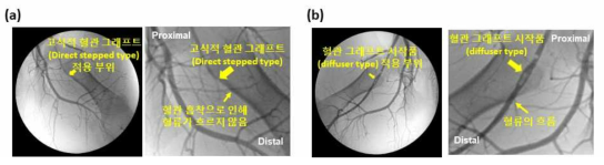 혈관 조영 검사(angiography)를 통한 혈관 그래프트 시작품을 적용한 부위에서의 혈관 개통성(vascular patency) 분석. (a) 고식적 혈관 그래프트 및 (b) 형상기억 고분자 기반 혈관 그래프트(diffuser type)