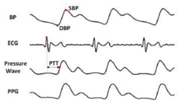 연속 혈압과 멀티모달 시스템으로부터 추출된 ECG, Pressure Wave, 그리고 PPG의 예시