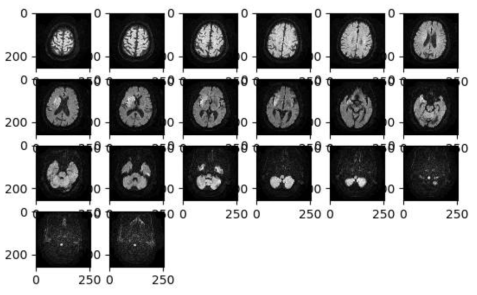 뇌경색 환자의 확상강조 자기공명영상을 3D convolutional neural network (CNN)로 분석하기 위해 DICOM 파일을 250 X 250 X 22 사이즈로 import 하는 과정
