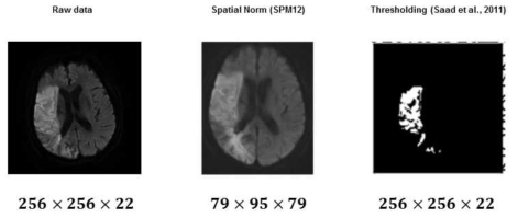 뇌경색 환자의 확상강조 자기공명영상을 SPM으로 normalization, thresholding technique으로 segmentation 하는 과정
