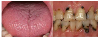 구강건조증 환자의 혀의 사진(좌측)과 치주질환 사진(우측)