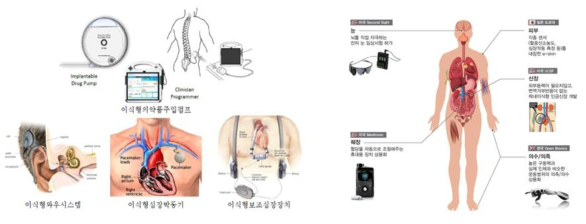 임플란터블 의료기기, 식약처/ 전자기기 인공장치, KISTEP, 2017