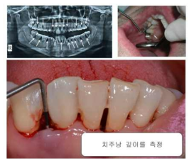 치주질환 진단법 : X-선 촬영, 직접확인 및 치주낭깊이 측정