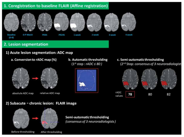 Steps of MR data processing and lesion segmentation