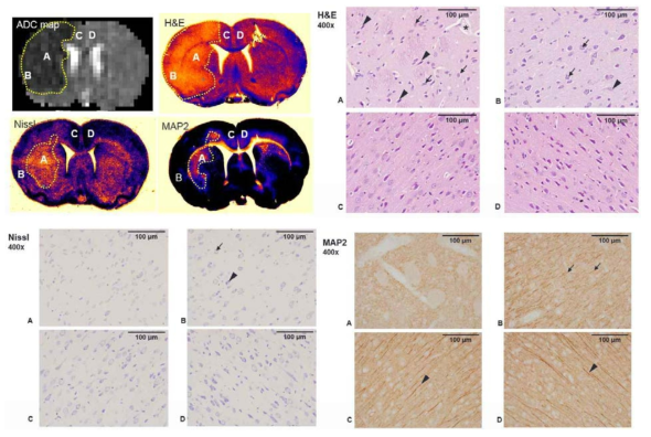 Pathology간 discrepancy가 있는 부위의 high magnification validation