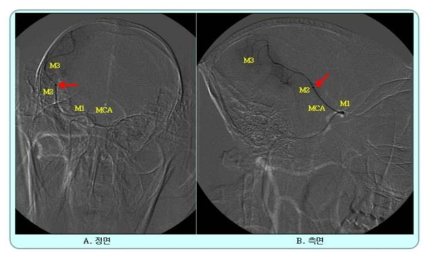 비수술적 허혈성 뇌경색 영장류 모델 제작을 위한 신경중재술 시행 대표영상