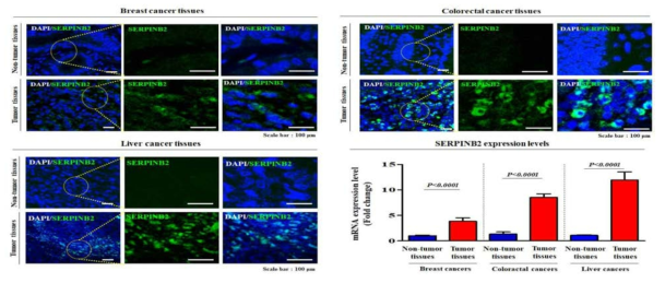 다양한 암조직 (유방암/대장암/간암)에서 SERPINB2의 발현 양상 확인