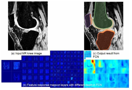 개발된 FCN (fully convolutional network)을 이용한 무릎 MR 영상에서의 뼈, 연골 분할 기법