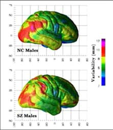 정상인과 조현병 환자의 뇌 이미지 사진