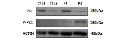 Comparision of PLC phosphorylation from normal group and dementia patient group. The intensity of PLC phosphorylation was measured using a western blot assay. Data are expressed as means ± SD (n = 2). CTL; control group, P; dementia patient group