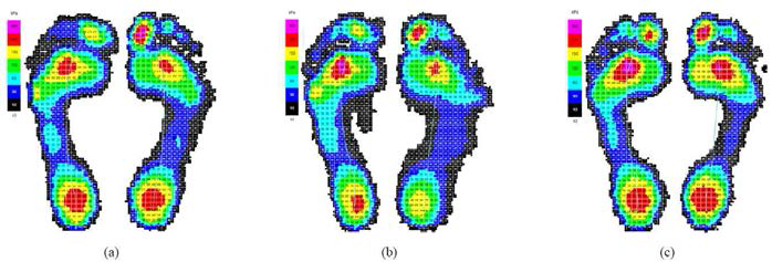 Differences in 2D plantar pressure distribution between scoliosis groups (a) right thoracic curve group (b) left lumbar curve group (c) double curve group