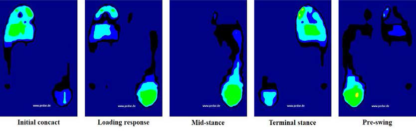 The plantar pressure distribution during stance phase of the right foot