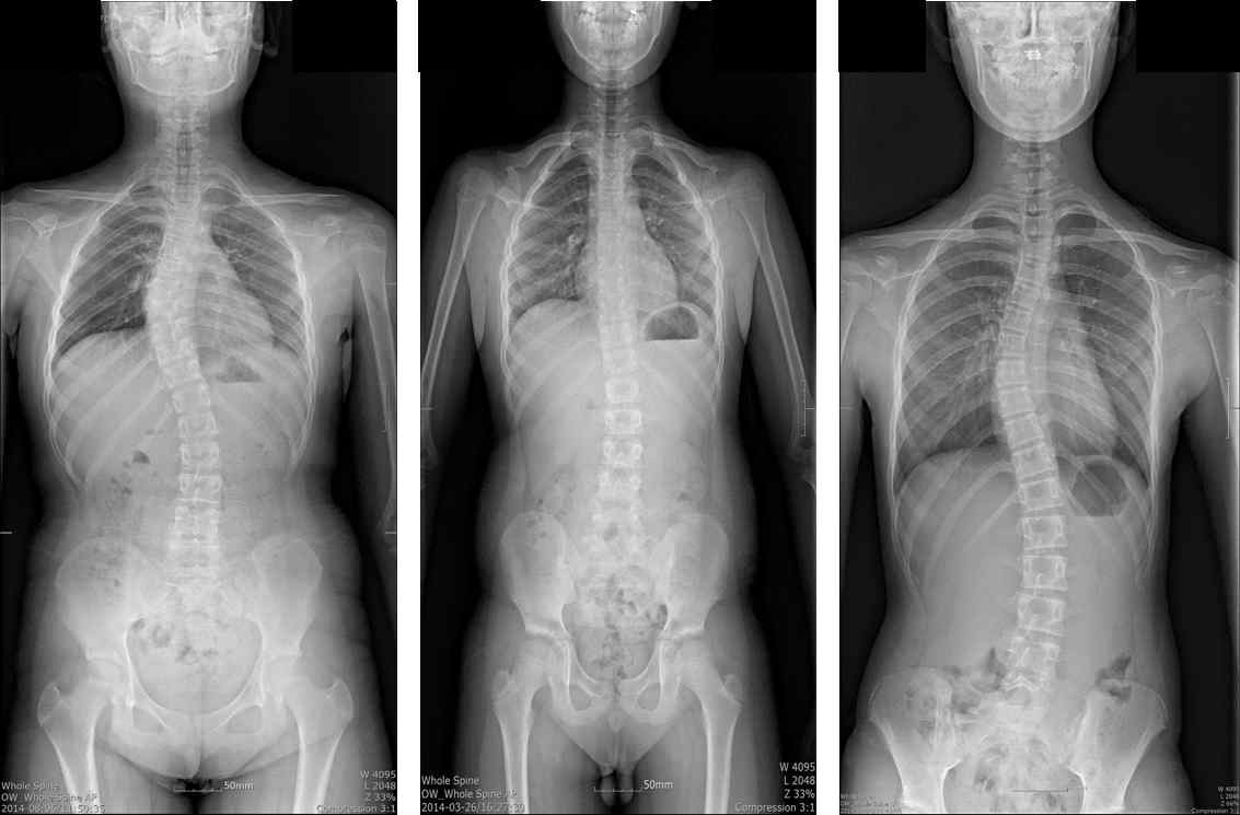 Scoliosis group