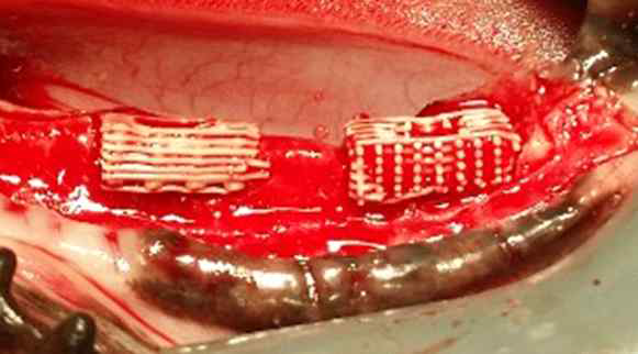 임플란트 주위 골 결손부위에 3D scaffold를 적용한 수술 사진