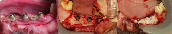 임플란트 주위염 골 결손부 모델 및 골 이식술 시행 사진