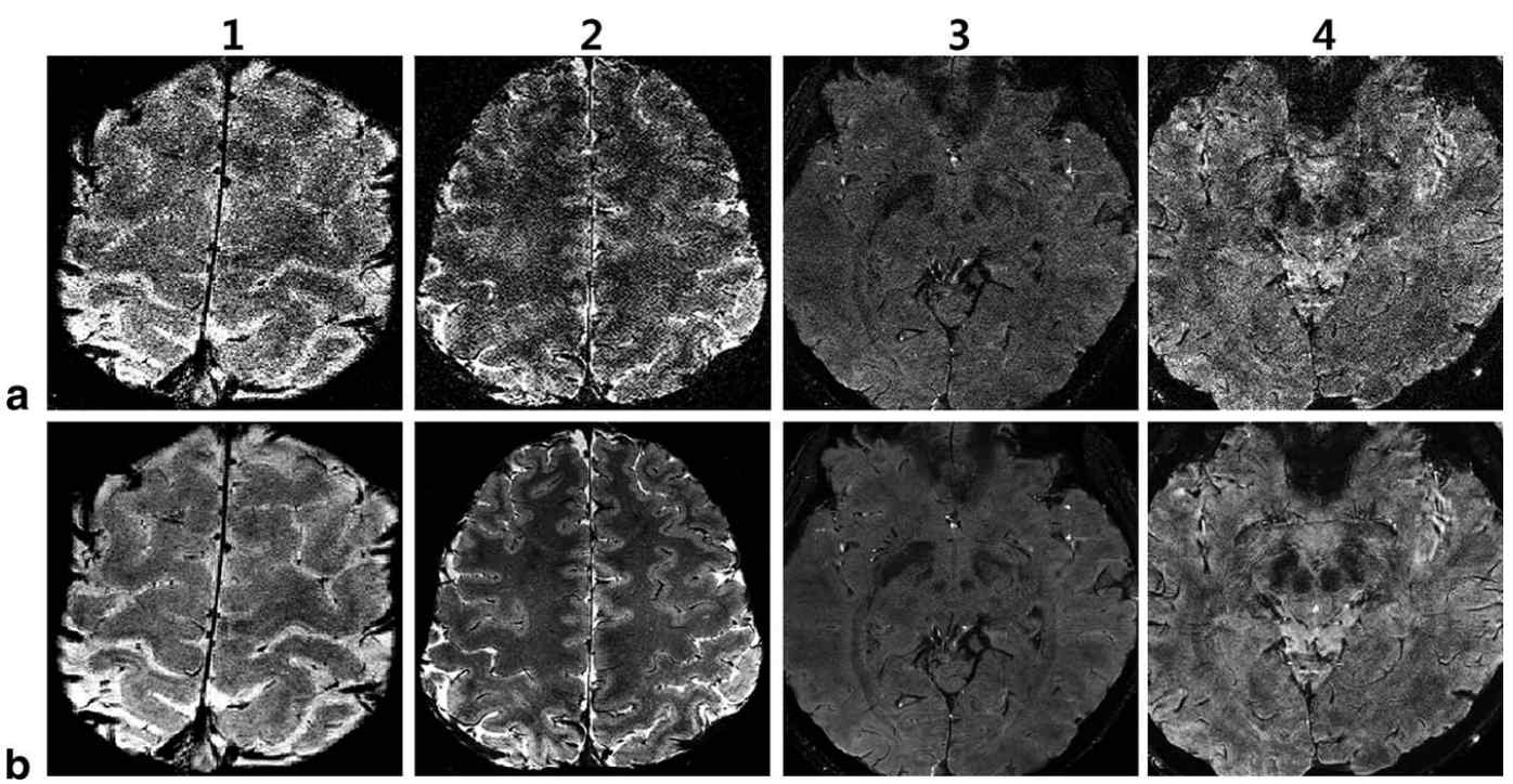 본 연구진이 개발한 시공간 비 근접 잡음(spatio-temporal, non-local denoising) 저감 기술 결과