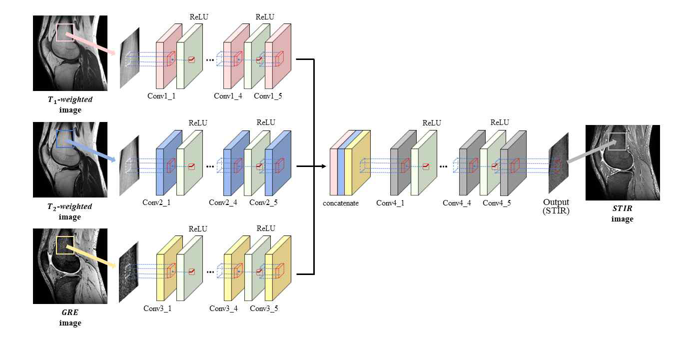 본 연구진이 개발한 합성곱 신경망 기반 다중 대조도 영상으로부터 STIR 영상 생성 기술