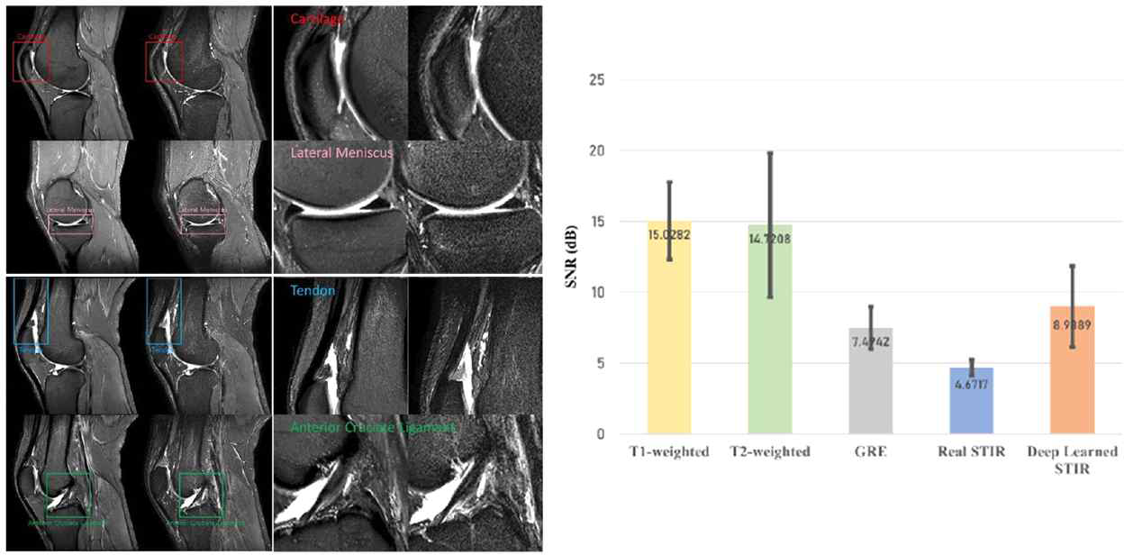 진단을 위해 활용하는 부위에 대한 기존의 STIR 영상과 본 연구진이 개발한 STIR 영상 및 SNR 수치 비교