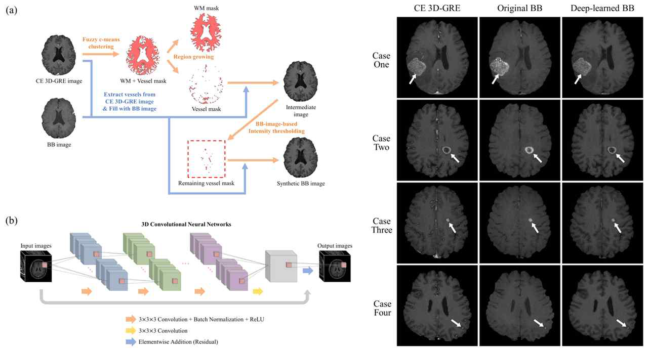 본 연구진이 개발한 3D 합성곱 신경망 기반 전이성 뇌종양 판별 영상 생성 기술 및 결과 영상